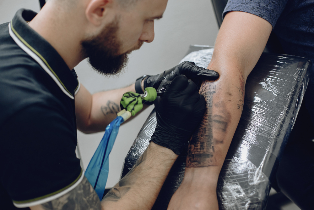 Laser Tattoo Removal in Coimbatore
